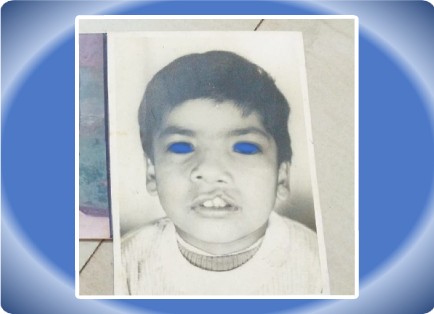 CLEFT LIP